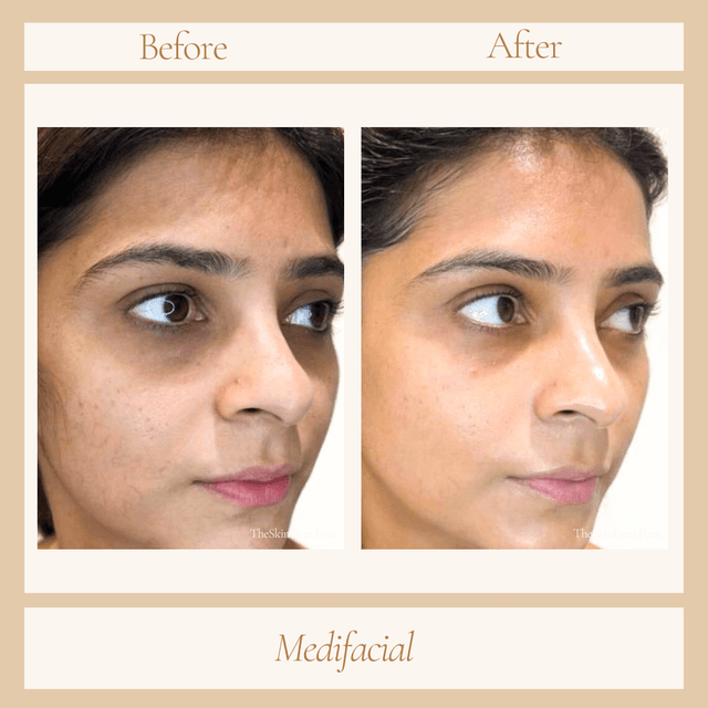 Facial
