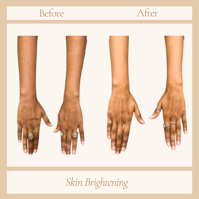 skin brightening Treatment