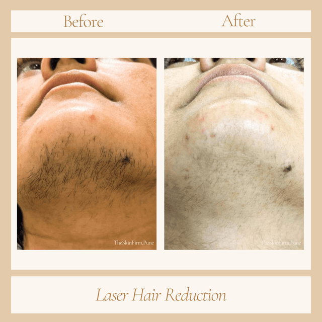 Laser Hair Removal
