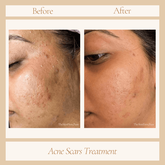 Acne Scar Treatment