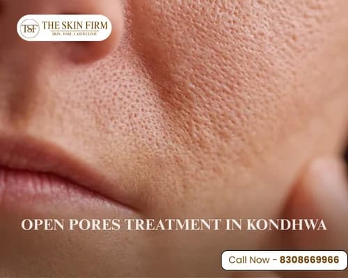 Open Pores Treatment in Kondhwa