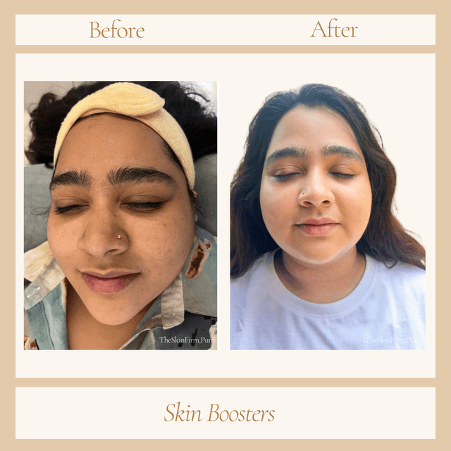 Skin Boosters