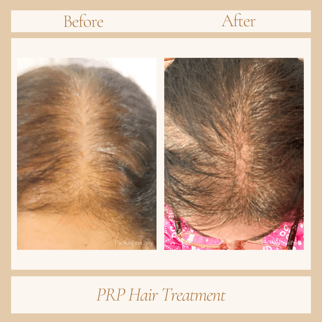 Hair Treatment