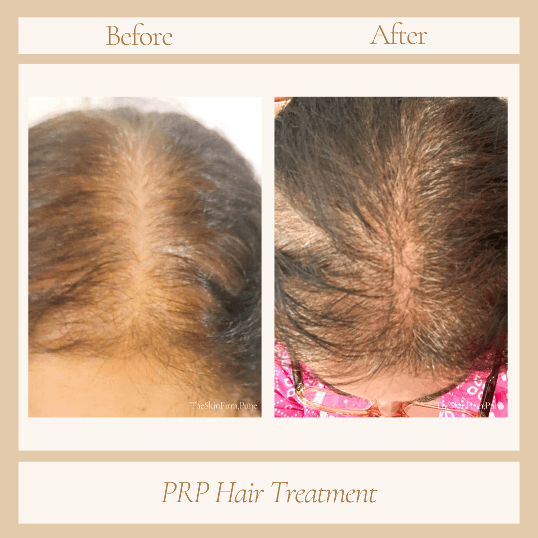 Treatment 18