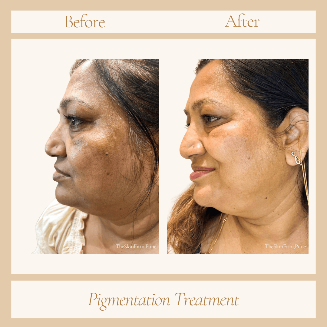 Treatment 6