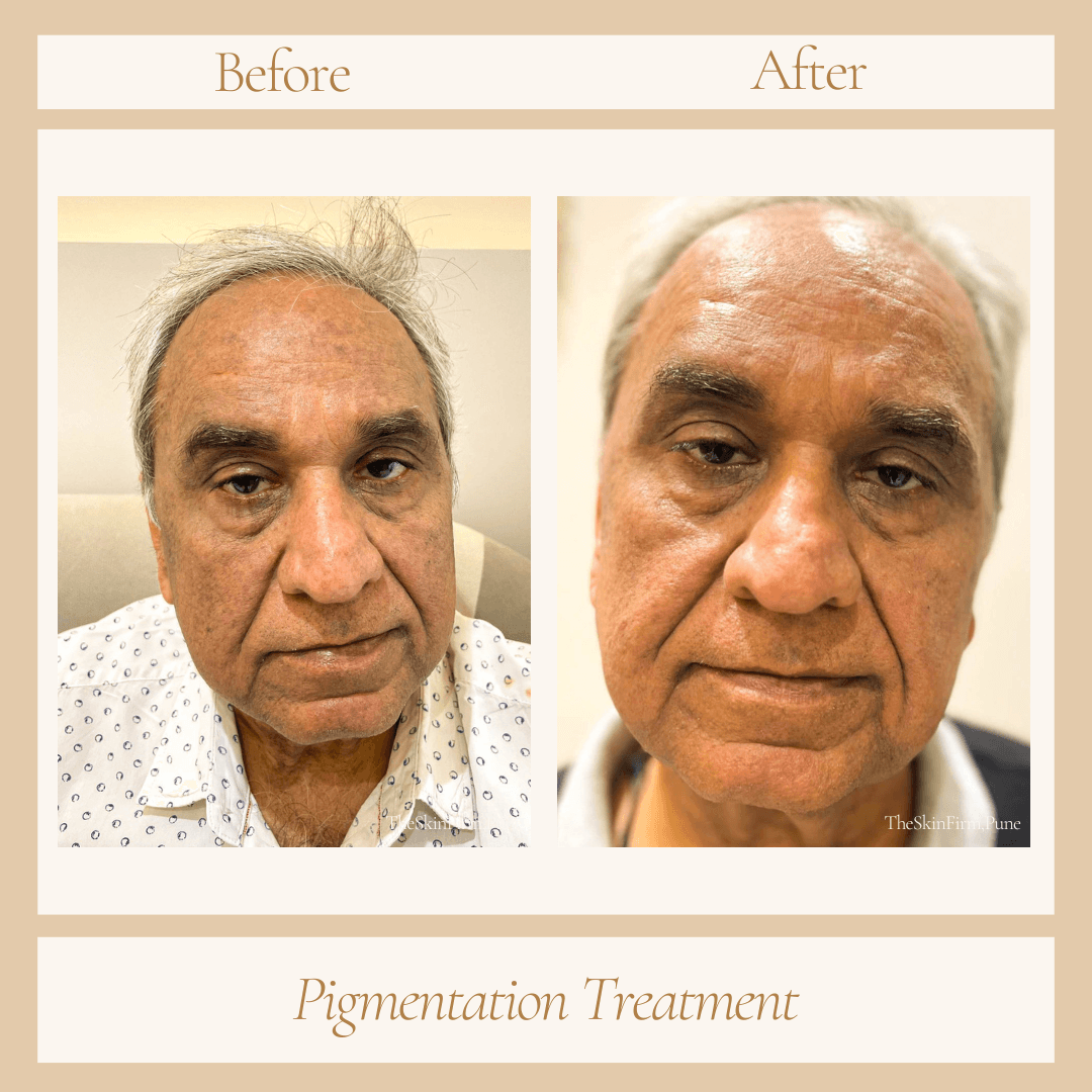 Treatment 7