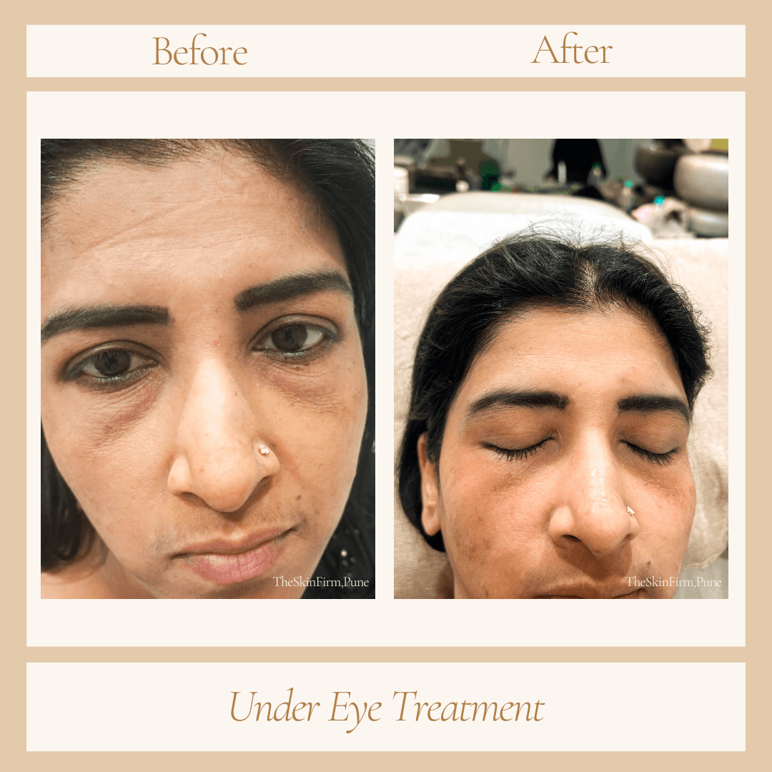Treatment 9