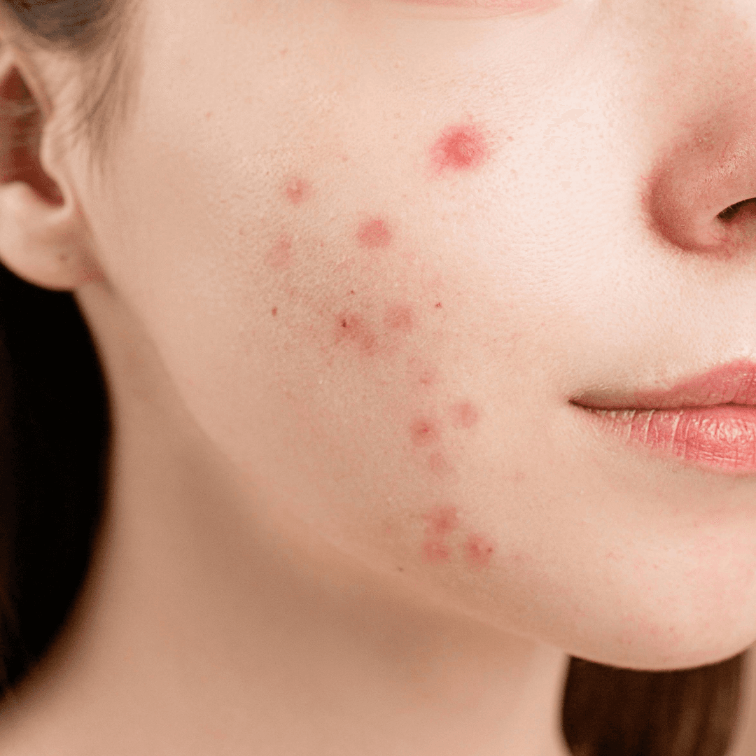 Stubborn Acne Scars?