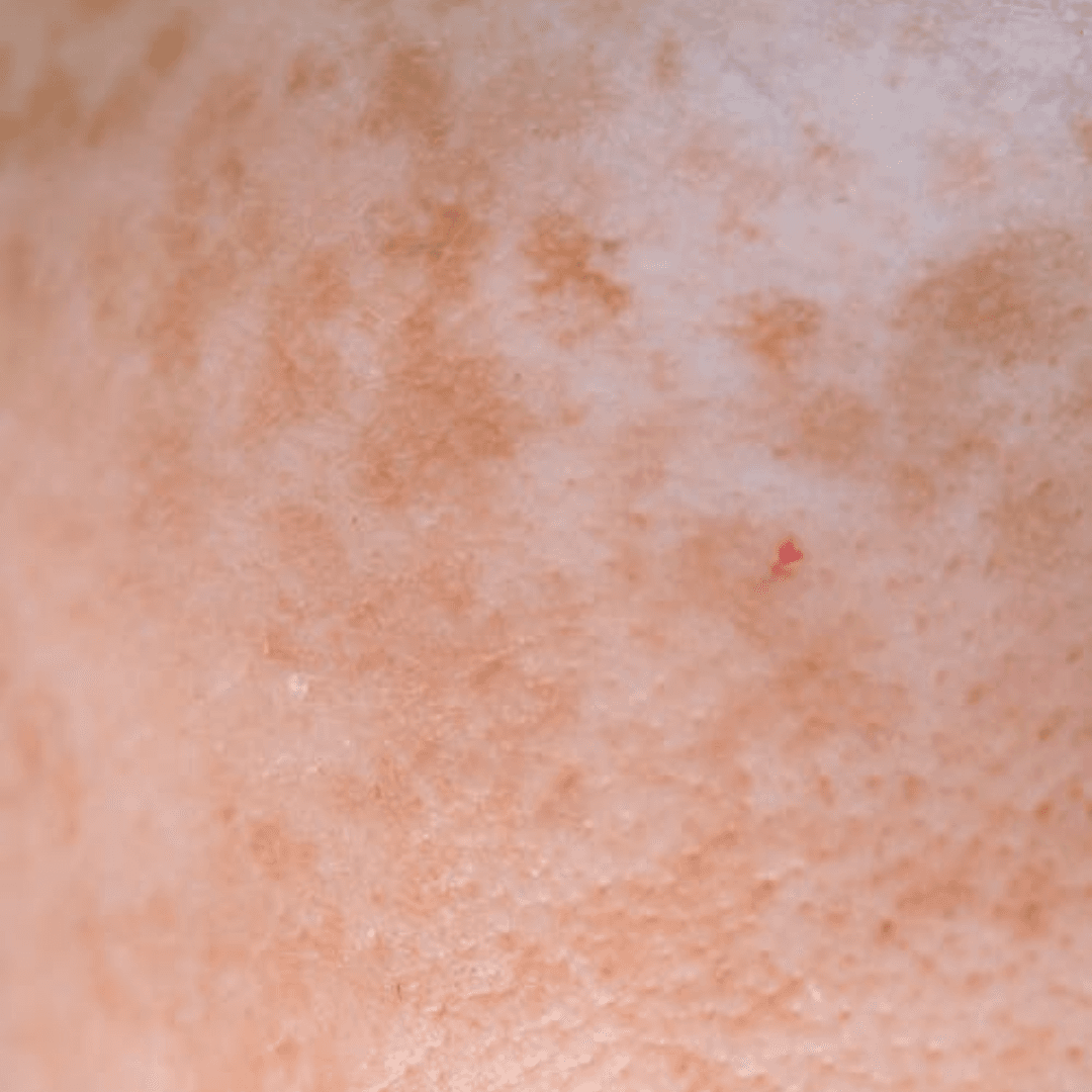 Pigmentation Treatment