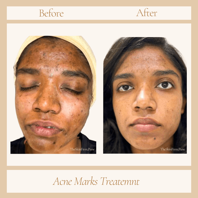 Acne Treatment