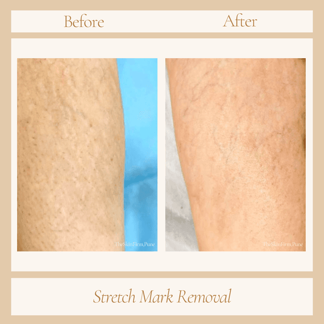 Stretch Marks