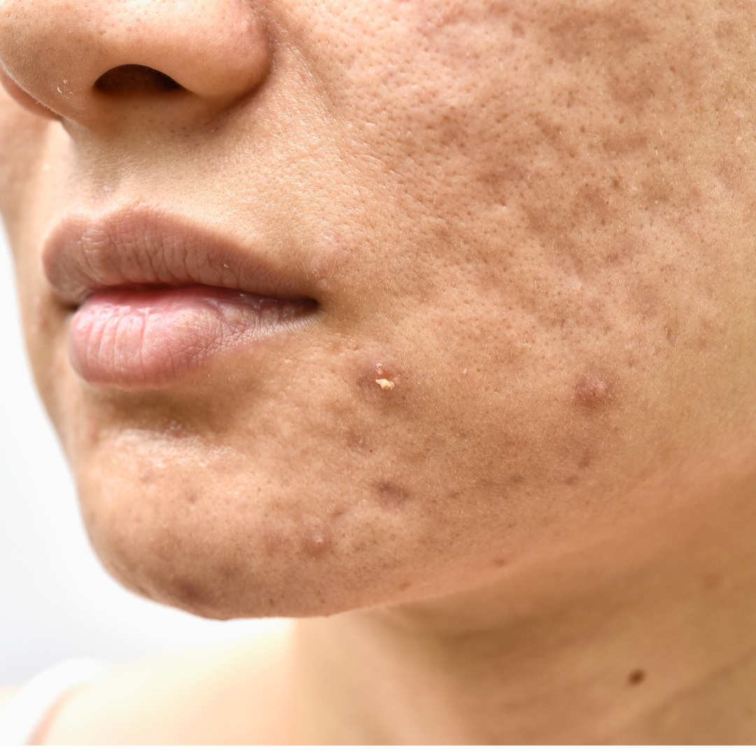 Acne Scars & Marks Treatment