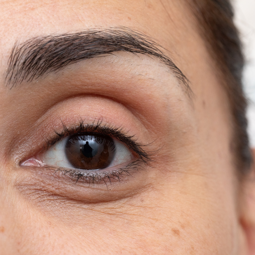 Dark Circle & Under Eye Treatment