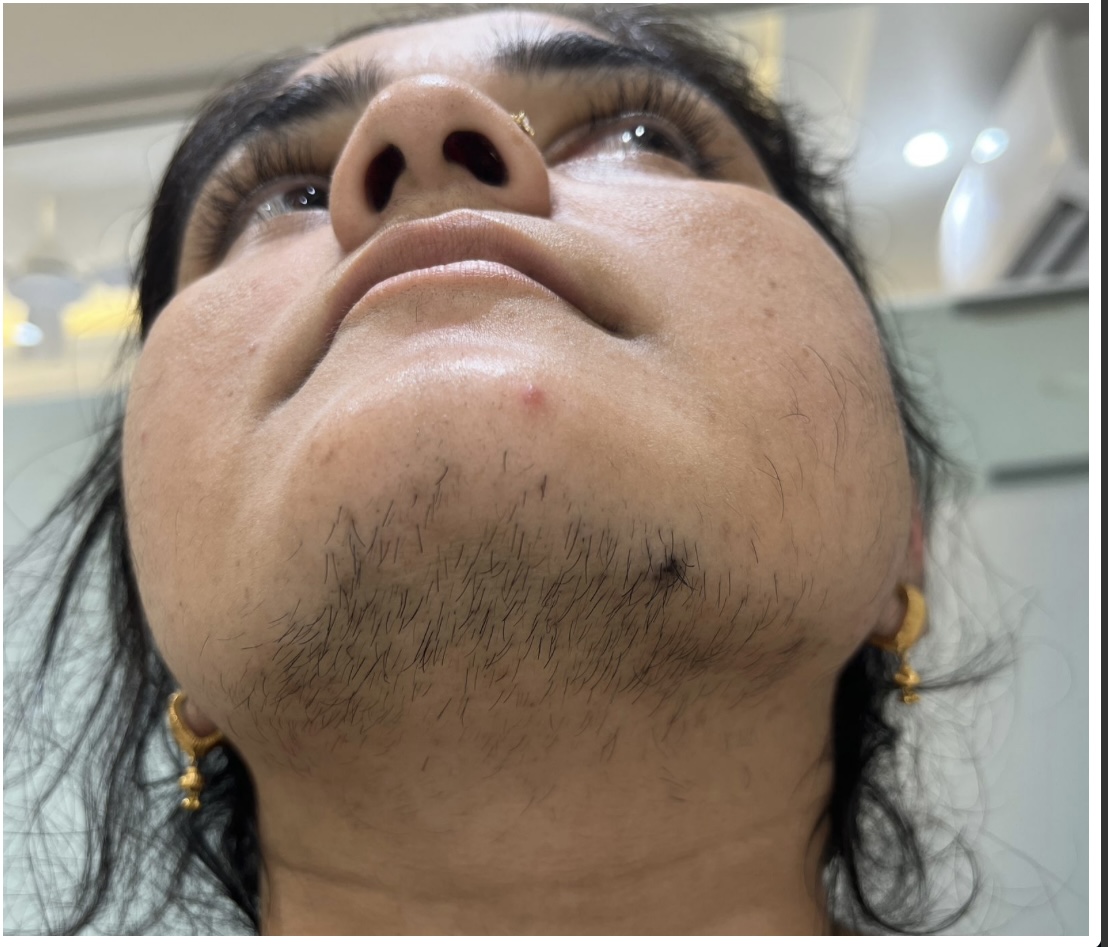 Before Laser Hair Reduction