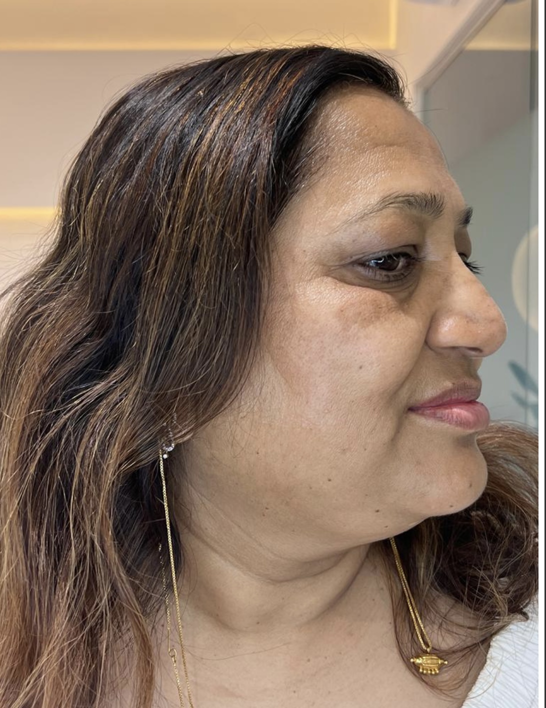 After Pigmentation Treatment
